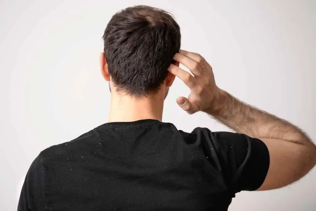 Dandruff Home Remedies in Tamil