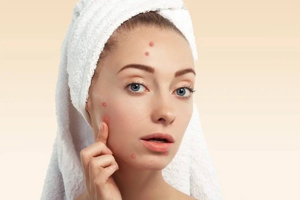 Pimples Home Remedies in Tamil